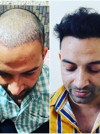 Hair Restoration