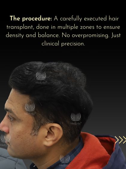 The procedure involved a carefully executed hair transplant in multiple zones to ensure density and balance.