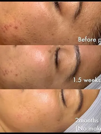 This before and after sequence shows the power of our chemical peel treatments over two months. You can see a significant reduction in acne, scarring, and pigmentation, revealing smoother, clearer skin.