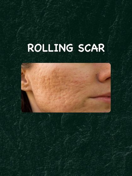 Rolling scars create a wave-like or uneven texture on the skin. Subcision is a technique I often use to release the fibrous bands that pull the skin down, creating a smoother surface.