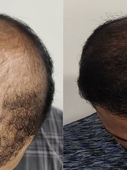 This patient had noticeable thinning across the crown. My approach was to strategically place grafts to build density and create the illusion of much thicker hair, which you can see in the result.