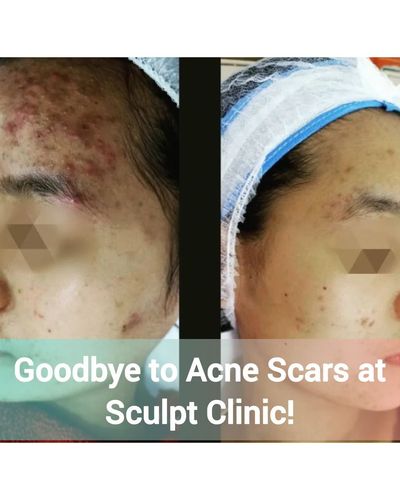 Acne, Pigmentation & Scar Treatments