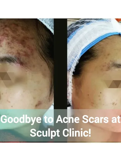 Here you can see a remarkable improvement in severe acne and subsequent scarring. Our personalized treatment plans target active acne to reduce inflammation and then focus on smoothing skin texture and fading scars for a clearer complexion.
