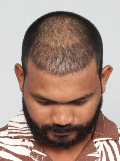 A 10-month transformation for a patient with diffuse pattern baldness. With 2400 grafts, we restored his look and confidence.