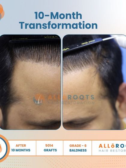 This 10-month transformation is a powerful example of tackling advanced Grade 6 baldness. With 5014 grafts, we achieved remarkable coverage and density, as seen from all angles.