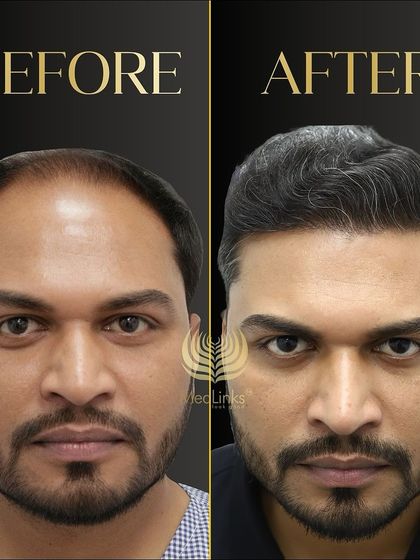 This before and after comparison shows a dramatic improvement in hair density and hairline. The patient looks younger and more confident.