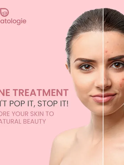 Don't pop it, stop it. The best way to treat acne and prevent scarring is to address it with a proper medical treatment plan that restores your skin's natural beauty.