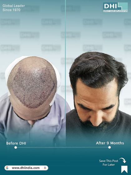 This image shows the client's head immediately after the procedure compared to the 9-month result. It offers a transparent look at the process, from the day of the transplant to the final, dense outcome.