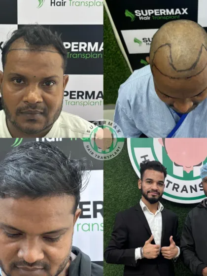 Just 4 months in and the result is already adorable. This shows the initial growth phase and the promise of a full head of hair.