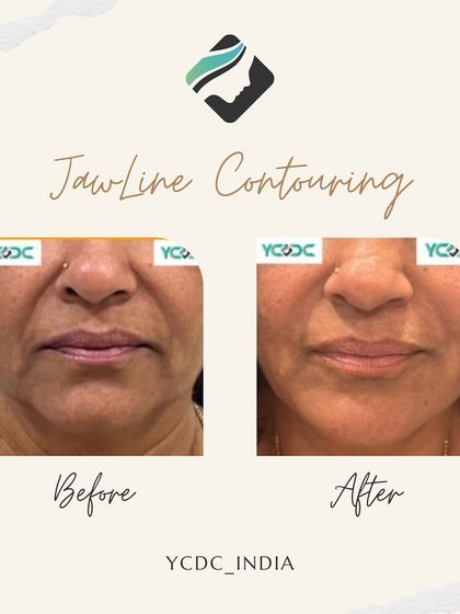 A frontal view of a jawline contouring procedure. Using hyaluronic acid fillers, I was able to soften the appearance of jowls and create a more defined lower face, resulting in a subtle lift.