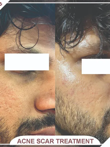 This image highlights the successful treatment of deep acne scars, showing a much smoother skin surface after our intervention.