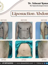 Body Contouring