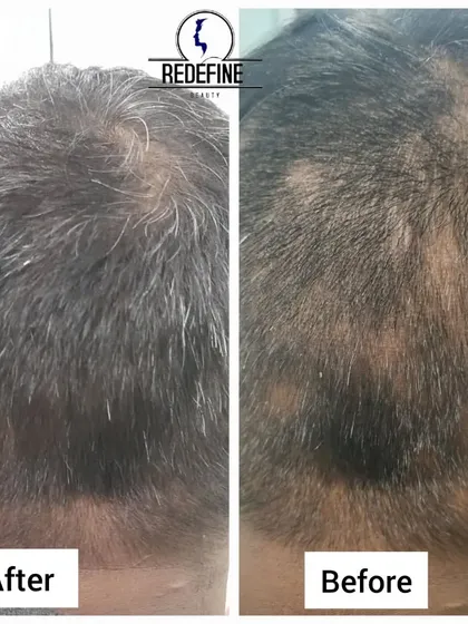 This before and after image shows the successful treatment of alopecia areata on the back of the head. The patchy hair loss has been completely resolved with full, healthy hair growth.