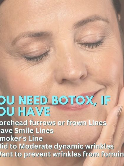 You may benefit from Botox if you have concerns like forehead furrows, frown lines, smile lines, or smoker's lines. It is also highly effective in preventing new wrinkles from forming.