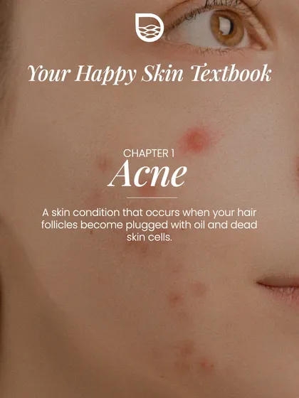 This is Chapter 1 of my Happy Skin Textbook: Acne. It is a condition that occurs when hair follicles become plugged with oil and dead skin cells, requiring a targeted approach.
