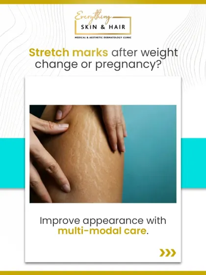 Stretch marks from pregnancy or weight changes are a common concern. I use a combination of advanced treatments, tailored to your specific skin needs, to significantly improve their appearance and restore your skin's texture.