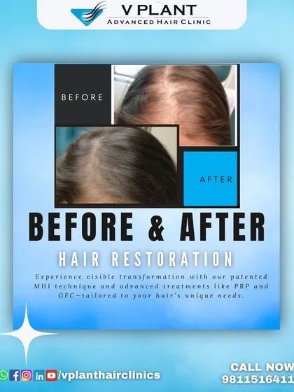The proof is in the results. This before and after image clearly shows the visible transformation achieved through our patented MHI technique combined with advanced treatments like PRP and GFC, restoring hair density and scalp coverage for a fuller, healthier look.