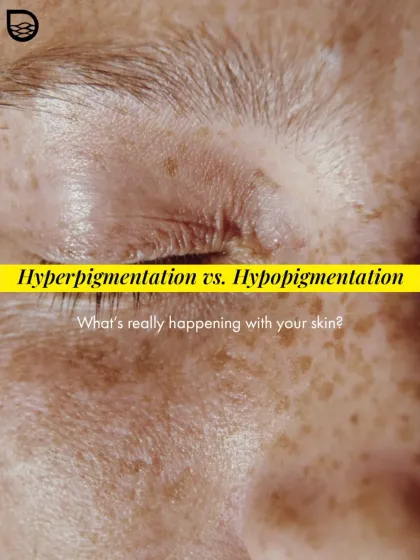 Are you experiencing hyperpigmentation or hypopigmentation? This image introduces the key question to help you understand what's really happening with your skin's melanin production.