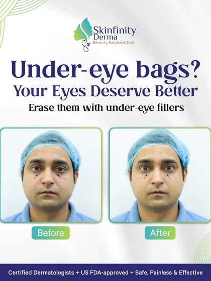 Tired of looking exhausted even when you are not? Under-eye hollows and dark circles can be effectively treated with our precise, non-surgical filler treatments. We restore lost volume to give you a naturally refreshed and brighter appearance, helping you look as good as you feel.