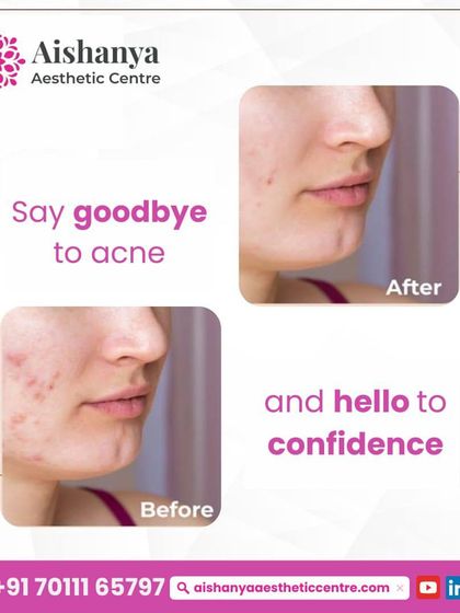 From active breakouts to confidence. This before-and-after collage is a reminder that with the right treatment plan, you can say goodbye to acne and hello to clear, healthy skin.