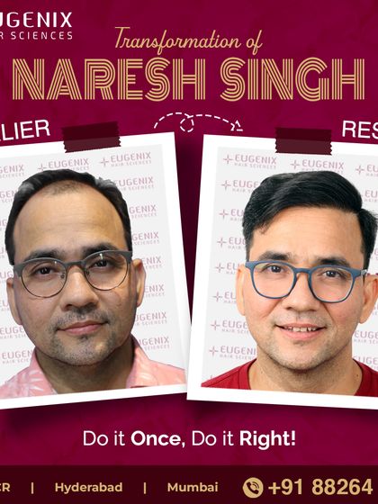 The complete transformation of Naresh Singh, showcasing a restored hairline and renewed look.