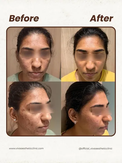 This patient came to us with persistent acne and post-inflammatory hyperpigmentation. By combining targeted in-clinic treatments with a simple at-home routine, we were able to significantly clear the breakouts and even out her skin tone, revealing a much healthier complexion.