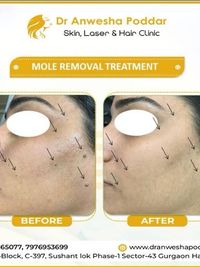 Mole, Wart & Skin Tag Removal