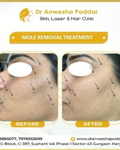 Mole, Wart & Skin Tag Removal