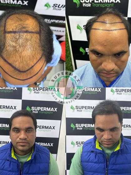 Another 4.5-month adorable result. We focus on creating a look that suits your face and age.