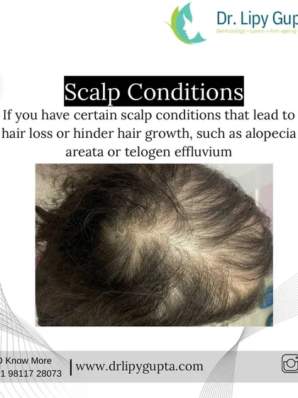 Certain scalp conditions like alopecia areata or telogen effluvium directly lead to hair loss. For these diagnosed conditions, PRP therapy can be a vital part of the treatment plan to manage the issue and promote regrowth.