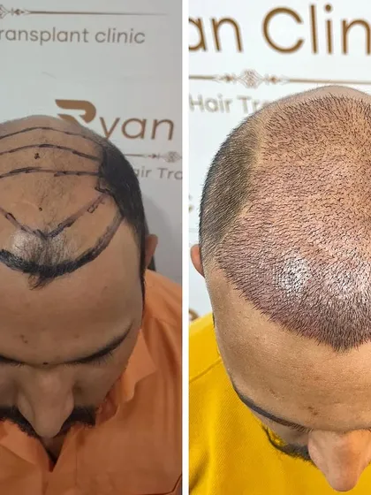 Before and after the hair transplant procedure. The hairline is marked and designed, and then the area is filled with high density grafts for a complete transformation.