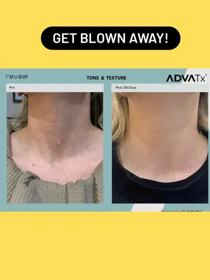 The neck is one of the first areas to show signs of aging. This before and after result from a single ADVA Tx session demonstrates a dramatic improvement in skin tone and texture, effectively turning back the clock on this delicate area.