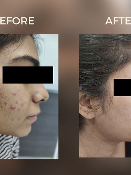 This transformation showcases how our targeted acne treatments, including the Carbon TriBeam laser, effectively clear active breakouts and reduce inflammation for healthier skin.