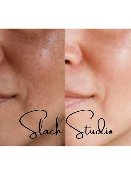 This close-up shows the skin texture becoming smoother and more refined after the Korean Glass Skin treatment.