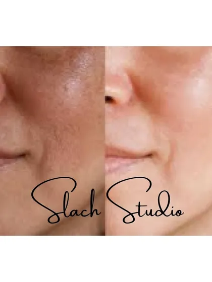 This close-up shows the skin texture becoming smoother and more refined after the Korean Glass Skin treatment.