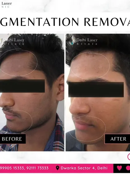 Another successful case of pigmentation removal. The treatment effectively reduced the dark patches on the forehead and cheeks, resulting in a brighter and more balanced skin tone.