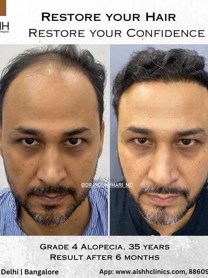 This is a 6-month result for a 35-year-old patient with Grade 4 alopecia. By carefully placing grafts, we restored his hairline and filled in thinning areas, completely transforming his look.