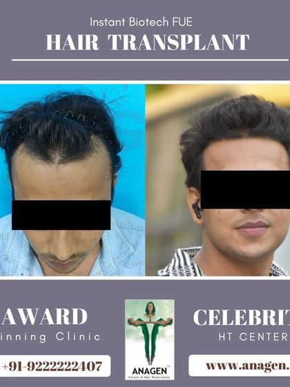 An amazing result from our Instant Biotech FUE hair transplant. This patient's receding hairline has been completely restored, giving him a more youthful look.