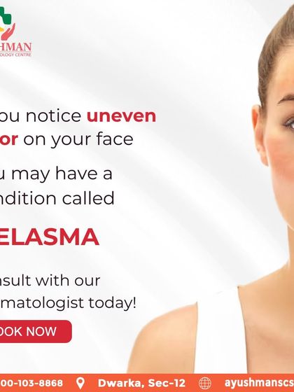 If you notice uneven color on your face, you may have a condition called melasma. I recommend consulting with a dermatologist to get a proper diagnosis and treatment plan.