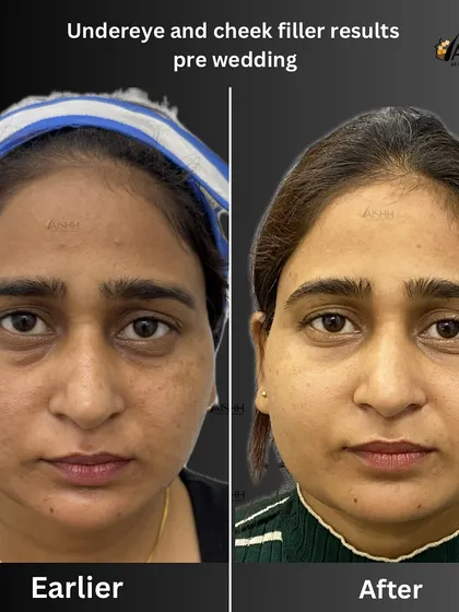 A tired appearance is often caused by volume loss under the eyes and in the cheeks. For this pre-wedding transformation, I used hyaluronic acid fillers to restore that youthful contour, complemented by chemical peels for an overall brighter complexion.