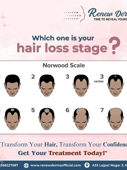 The Norwood Scale helps us identify the stage of male pattern baldness. Understanding where you are on this scale allows us to recommend the most effective treatment, as early intervention often yields the best results.