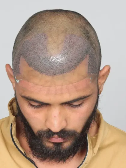 This is what a scalp looks like immediately after the procedure. Each dot is a carefully placed graft, the foundation of a future full head of hair.
