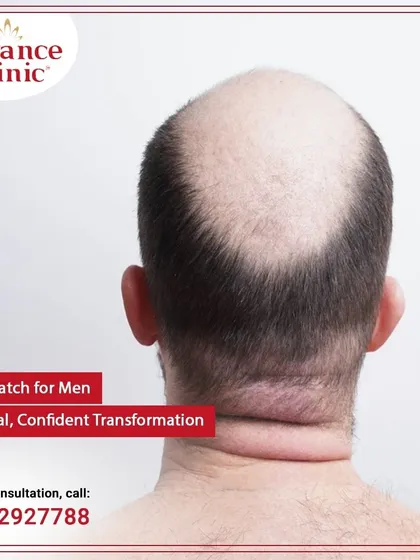 Many men come to me with male pattern baldness like this. I understand how it affects your confidence, which is why I offer a straightforward, non-surgical hair patch solution that works.