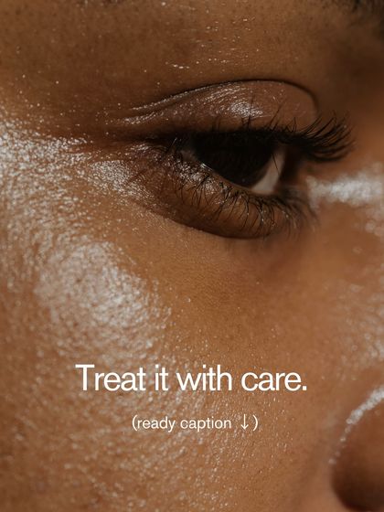 The delicate skin around the eyes must be treated with care. My under-eye peels are specifically formulated to reduce pigmentation and brighten this area safely.