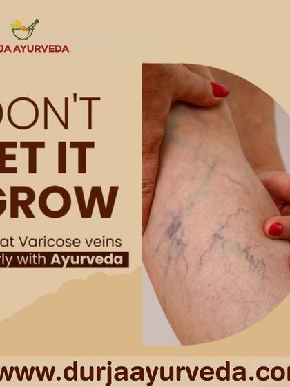 Varicose veins, or Siraja Granthi, can cause pain and discomfort. We recommend treating them early with Ayurvedic therapies that improve blood circulation and strengthen the vein walls.