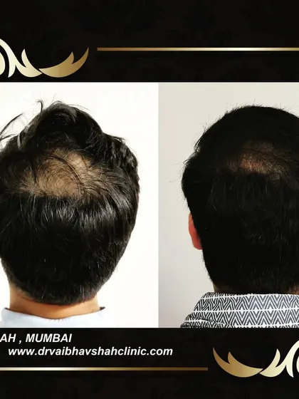 This patient's crown area now has a natural-looking whorl and excellent density, completely covering the area of previous hair loss.