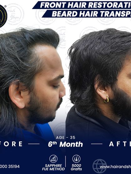 A side profile view showcasing the new, dense beard growth and restored hairline just 6 months after the combined procedure.