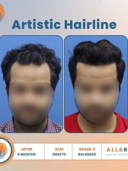 An artistic hairline is key to a natural result. This 8-month result for Grade 2 baldness, using 2330 grafts, shows how I meticulously design the hairline to be soft and irregular, avoiding a fake, pluggy look.