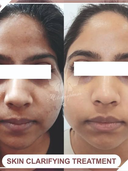 A wonderful transformation showing how our customized plans with peels and lasers can tackle pigmentation and acne scars for radiant, glowing skin.