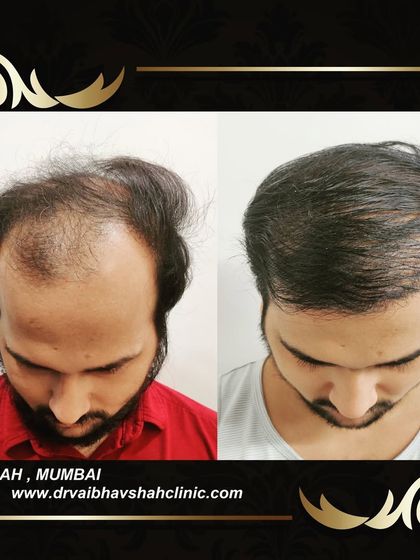 This top-down view shows just how much coverage was achieved. We successfully restored hair to the entire balding region.